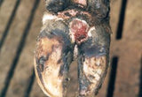 digital dermatitis, hairy foot wart, strawberry lesion, cow lameness, cow sore foot